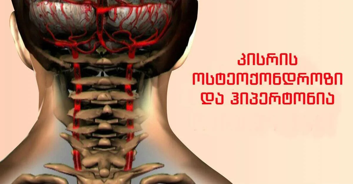 მსოფლიო მოსახლეობის 90% კისრის ოსტეოქონდროზისგან იტანჯება. აი, როგორ უნდა შეაჩეროთ ეს უსიამოვნო პრობლემა